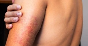 Deri Döküntüsü ve Halsizlik Hangi Hastalığın Belirtisidir? Olası Nedenler