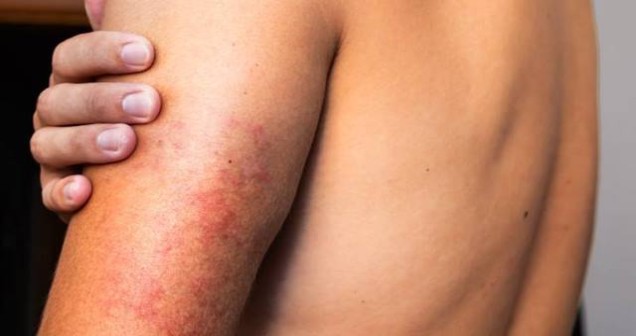 Deri Döküntüsü ve Halsizlik Hangi Hastalığın Belirtisidir? Olası Nedenler